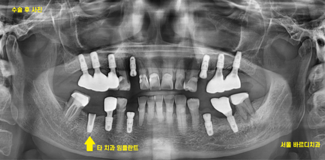 타치과 임플란트 as 수리 가능한 선동치과 관련 이미지 5