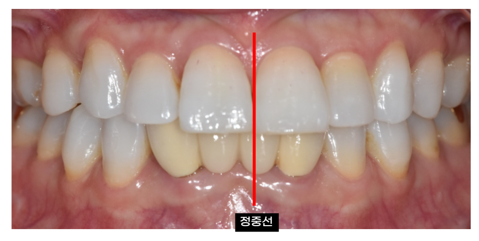 Solved My Concerns About Protruding Front Teeth with Partial Re-orthodontic Treatment of the Front Teeth image 2