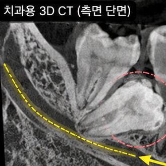자꾸 볼을 씹는다면, 사랑니 원인일 수 있습니다. 볼씹힘 관련 이미지 5