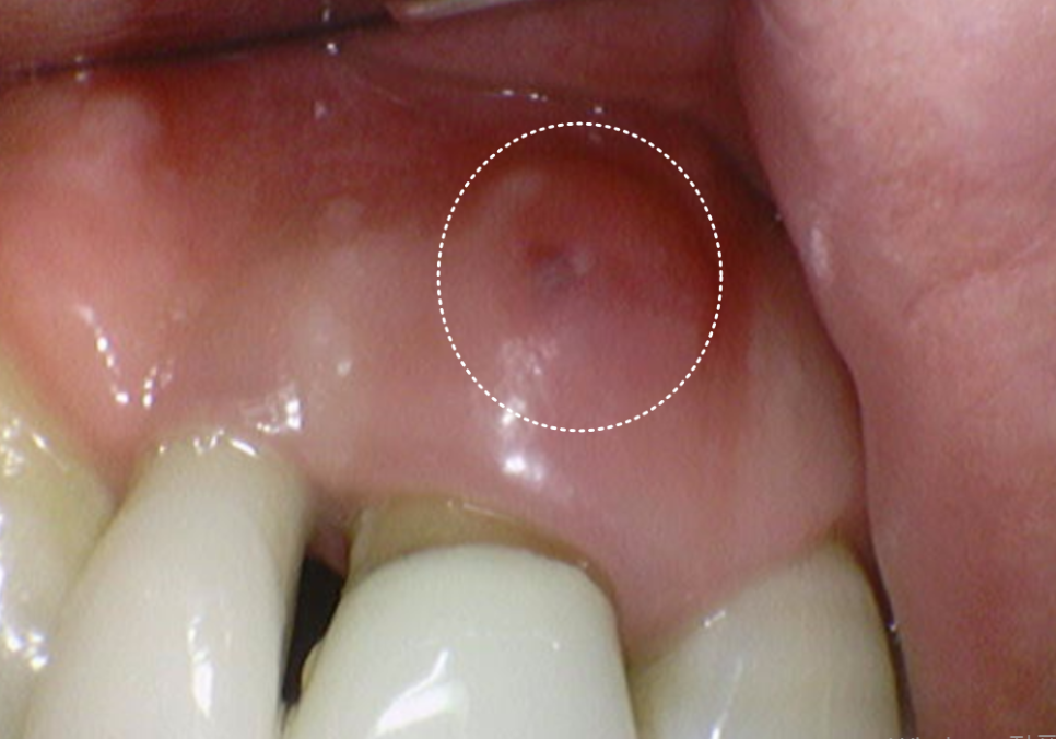 앞니 임플란트, 원내 기공소의 중요성을 아시나요? 관련 이미지 11