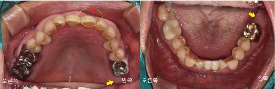 상일동치과 서울바르디치과 무절개 네비게이션 임플란트 치료증례 #3 관련 이미지 3