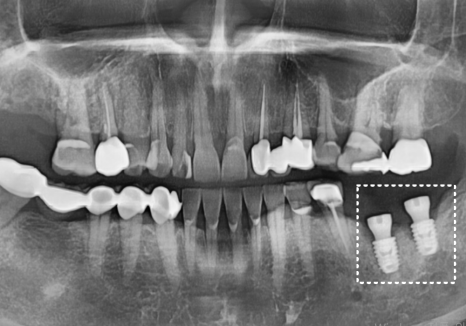 애써 심어둔 임플란트, 교체해야 된다구요? 냄새가 난다면 확인해보세요. 관련 이미지 13