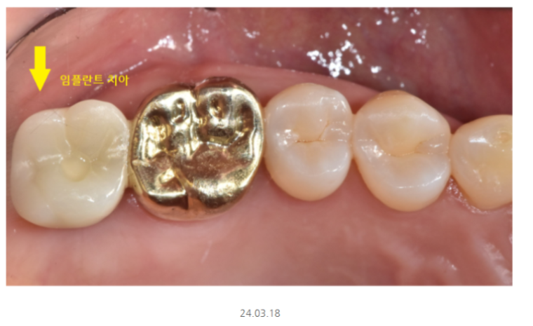 임플란트 관리 도대체 어떻게 해야 하는 건가요?? 관련 이미지 2