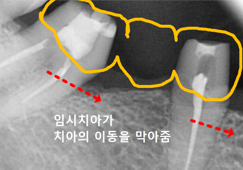 Honestly, Can an Unbroken Temporary Tooth Be Used Without a Crown? image 3