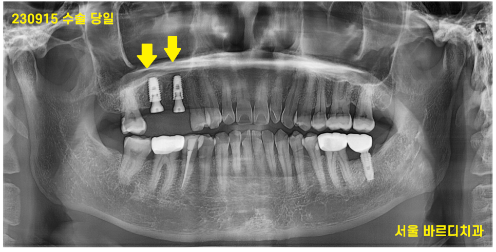 고덕동 치과 잇몸 주저앉음 느낌이 들었다면 늦었을 수도 있습니다. 관련 이미지 10