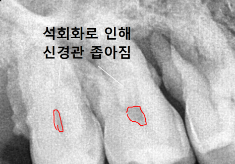치아 시림 증상 때문에 고민이신가요? 그렇다면 양치질 너무 열심히 하지 마세요. 관련 이미지 11