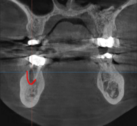 잇몸 물집 강일역 치과에서 원인 알아보고 임플란트로 치료했습니다. 관련 이미지 5