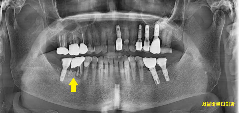암사동 치과 치아 뿌리 균열 금 갔을 때 임플란트 치료로 행복해지세요. 관련 이미지 2