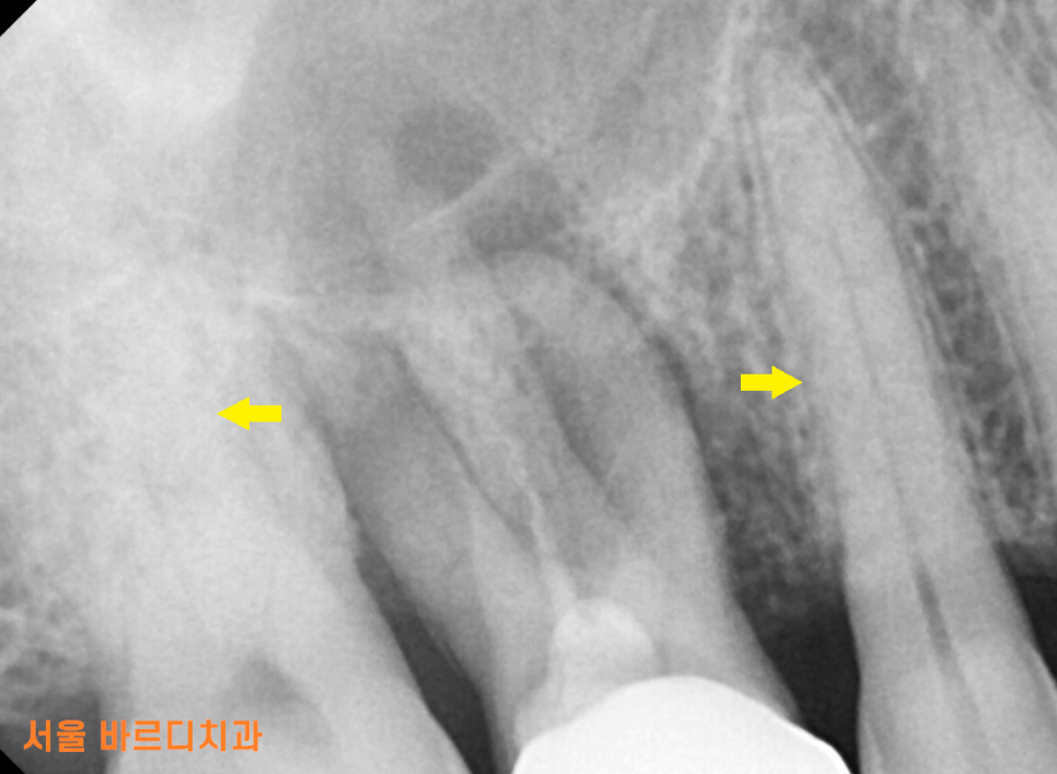 망월동 치과 염증이 심하면 임플란트 바로 못심어요 잇몸뼈 함몰 케이스 관련 이미지 4