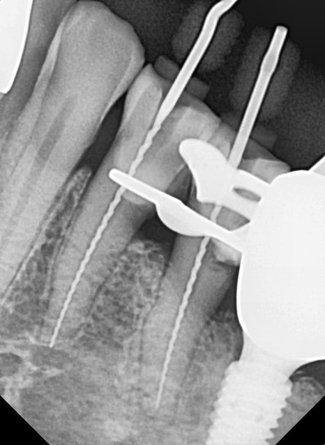고덕동치과 임플란트 정기검진, 미루다가 수십만 원 손해 봅니다. 관련 이미지 8