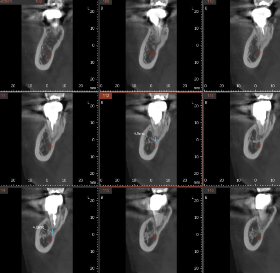 발치후 임플란트 시기 기다려야할까 바로 해야할까? 관련 이미지 3