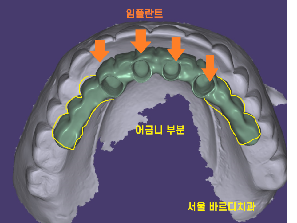 상일동 근처 치과 얇은뼈 틀니 안될 때 해결 방법은?? 관련 이미지 10