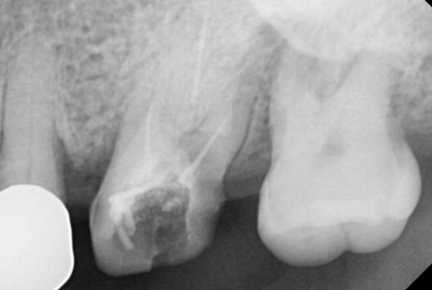 치아 크라운 빠짐 살릴 수 없을 때 강일역 임플란트 관련 이미지 4