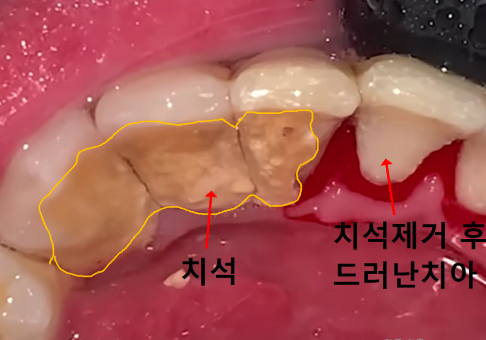고덕동 아래 앞니 임플란트 비용 줄이는 비법, 공개합니다. 관련 이미지 1