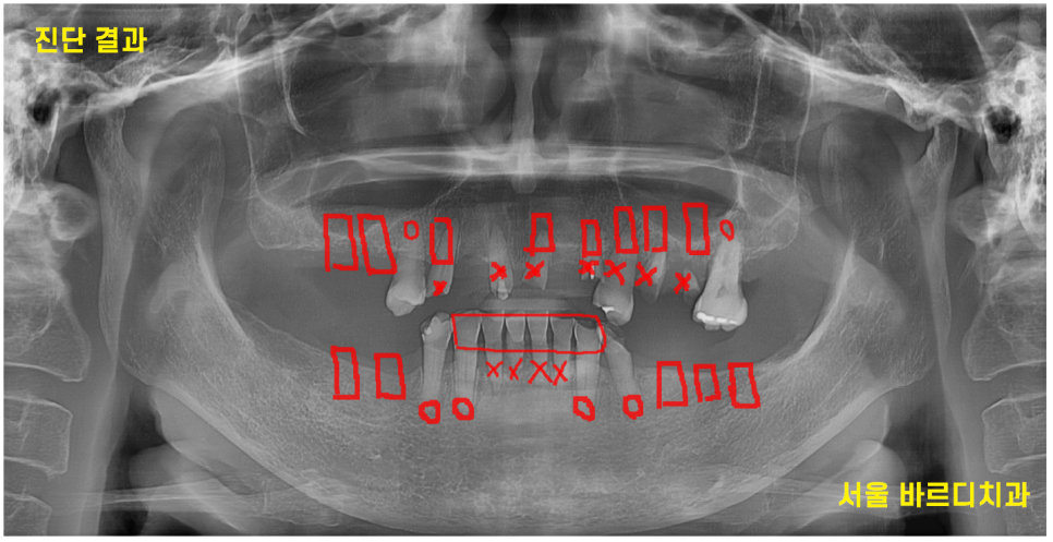 전체적인 치아 치료 13개의 임플란트를 식립한 환자분 관련 이미지 8