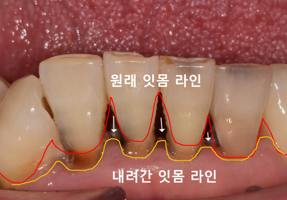앞니 음식물 끼임, 왜 젊을 때보다 더 자주 발생하는 걸까요? 까맣게 변한 앞니 치료 사례 관련 이미지 3