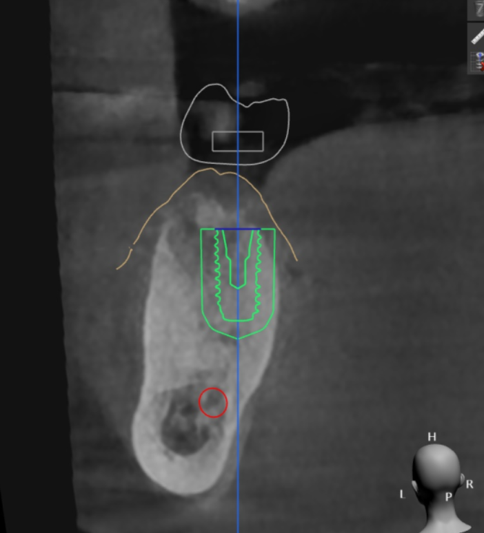 둔촌동 치과 80대 임플란트 가능한가요? 관련 이미지 10