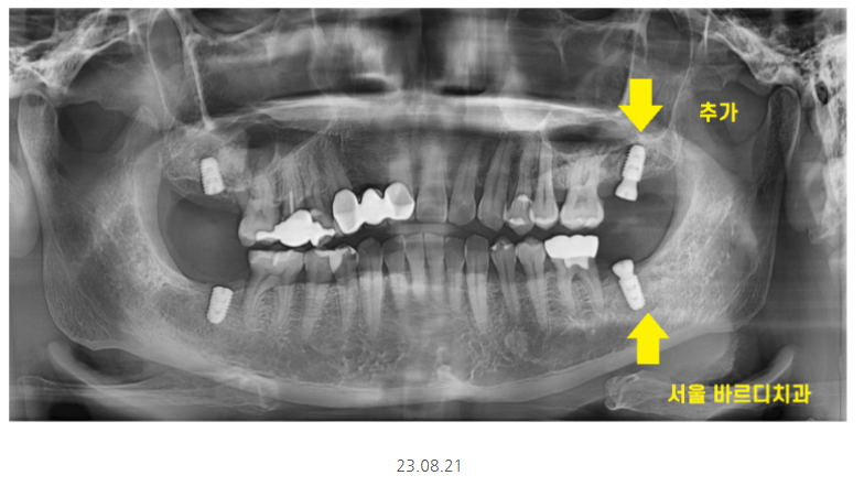 명일동 치과 임플란트 위아래 같이 할 수 있나요?? 관련 이미지 6