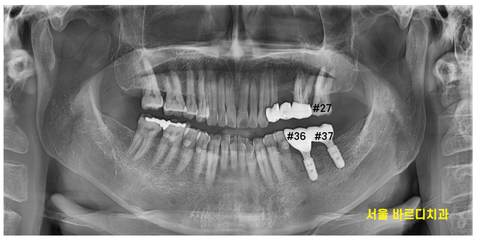 강일동 임플란트 씌운 치아 통증 불편할 때는 치과를 방문해주세요 관련 이미지 8