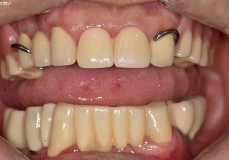 Godeok-dong Tooth Fracture: Check This Before Getting an Implant! Revealing the Criteria for Saving It image 9