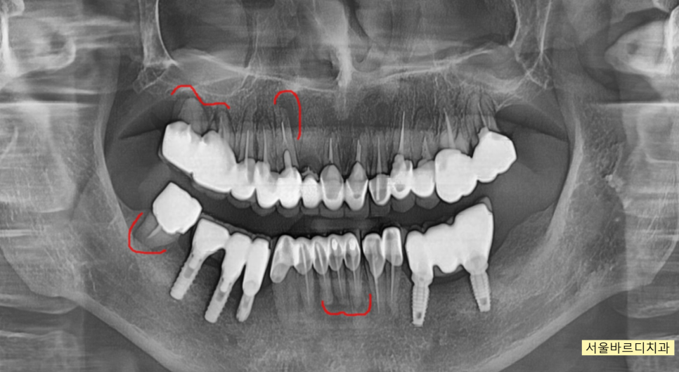 위아래 임플란트 동시에 하여 치료기간 단축하기 관련 이미지 2