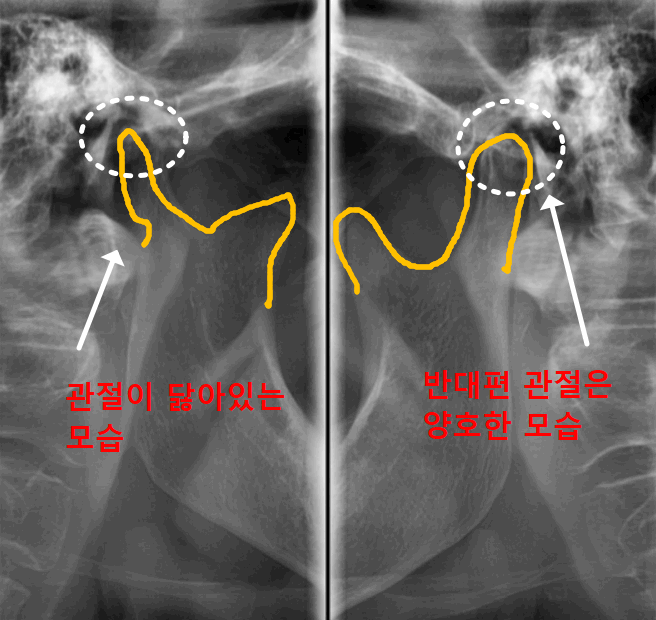 아침에 일어날 때 어금니가 욱신거린다면? 이 습관을 의심해 봐야 합니다. 관련 이미지 6