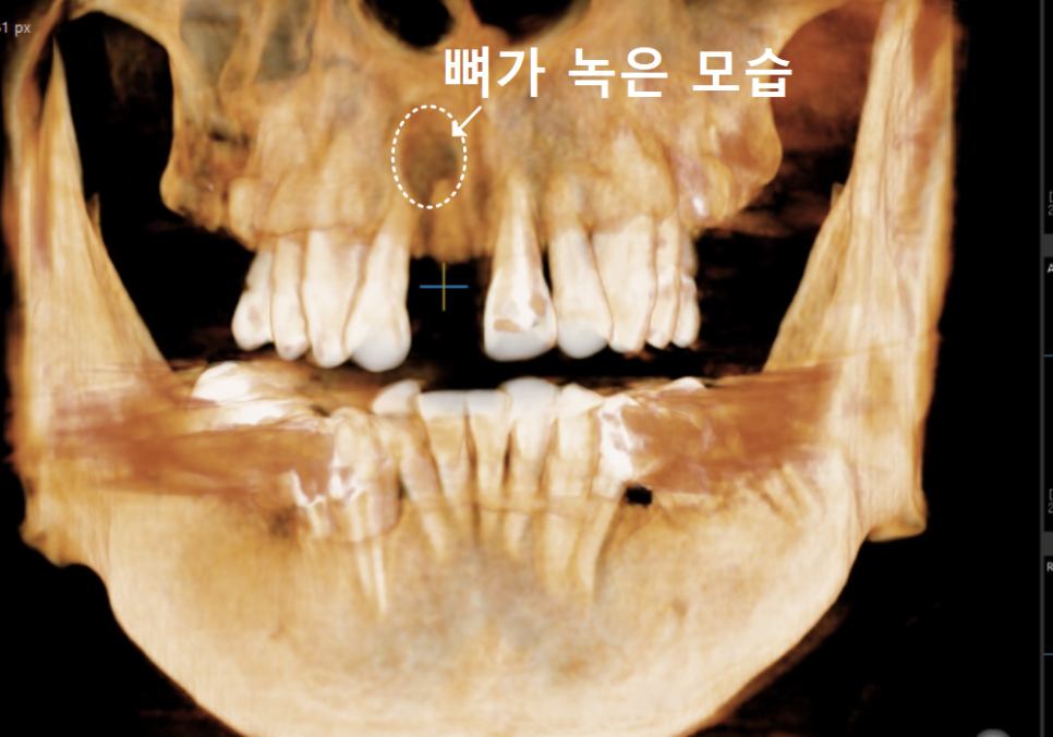 앞니 뿌리 염증, 자연치유될까? 아프지 않아도 치료가 필요한 이유 관련 이미지 7