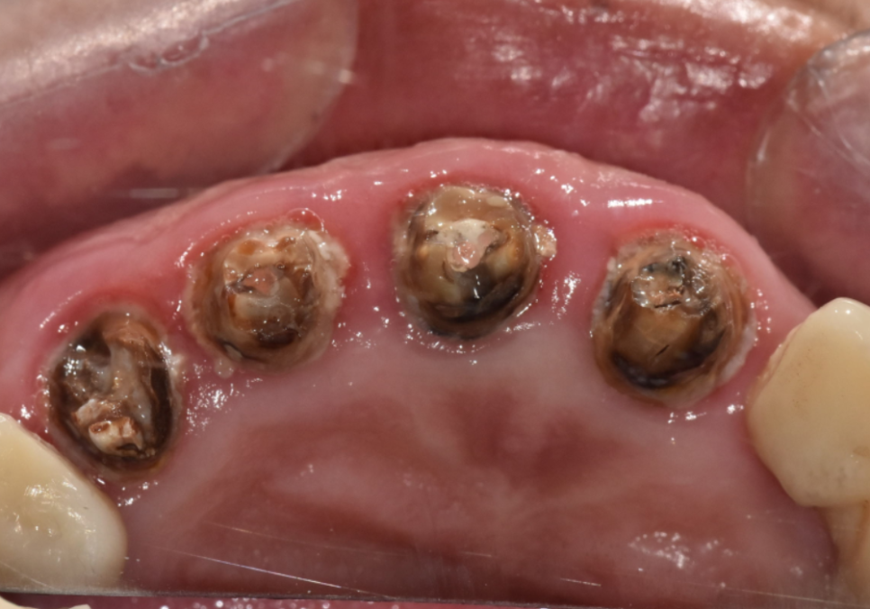 앞니 브릿지 탈락, 씌워둔 게 빠졌어요. 다시 붙일 수 있을까요? 관련 이미지 8