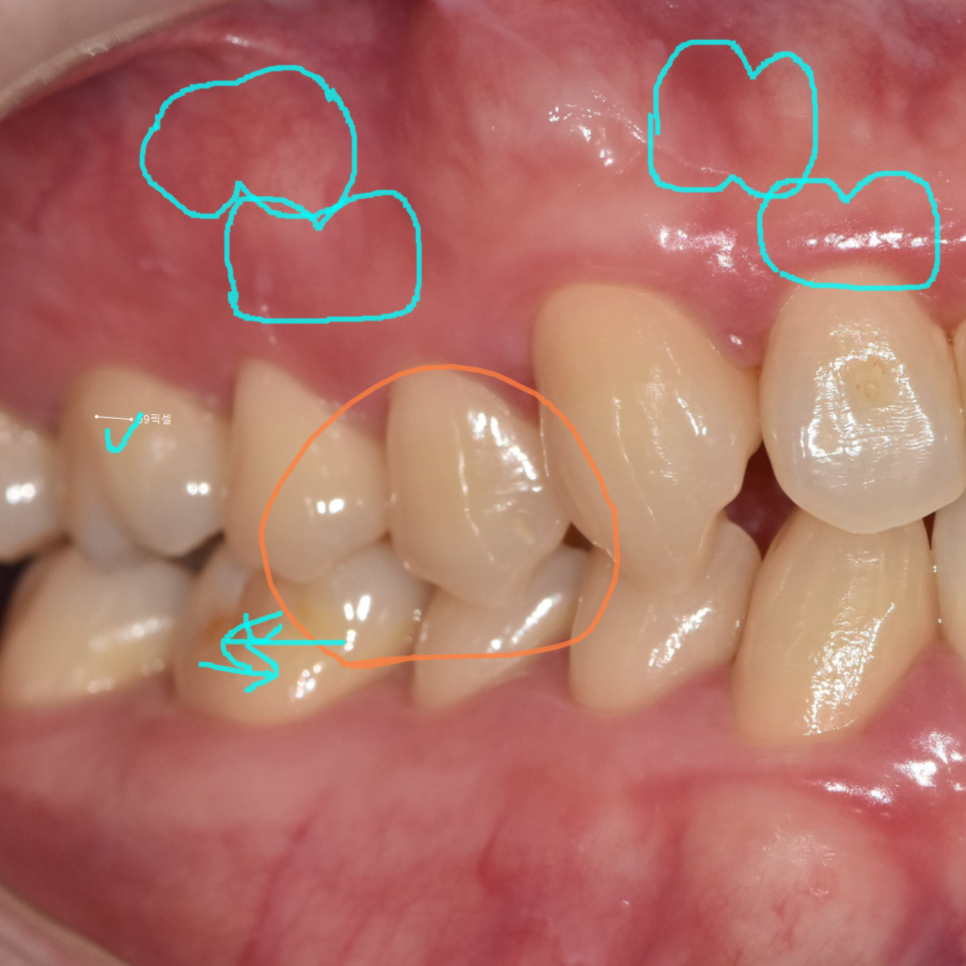 Sangil-dong Orthodontic Dentist: Do Protruding Front Teeth Really Need Orthodontic Treatment? image 7