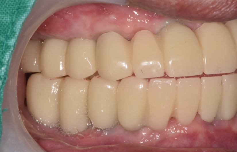 고덕역  치과 틀니쓰다 위아래 전악 임플란트 재건했습니다. 관련 이미지 12