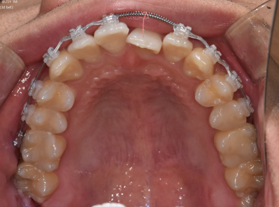 고덕역 교정치과 성인 부정교합 위아래가 거꾸로 물릴때는? 관련 이미지 6
