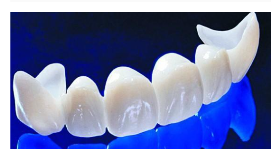 앞니 잇몸 검은색 라인 오래된 pfm 보철 교체하세요!! 관련 이미지 7