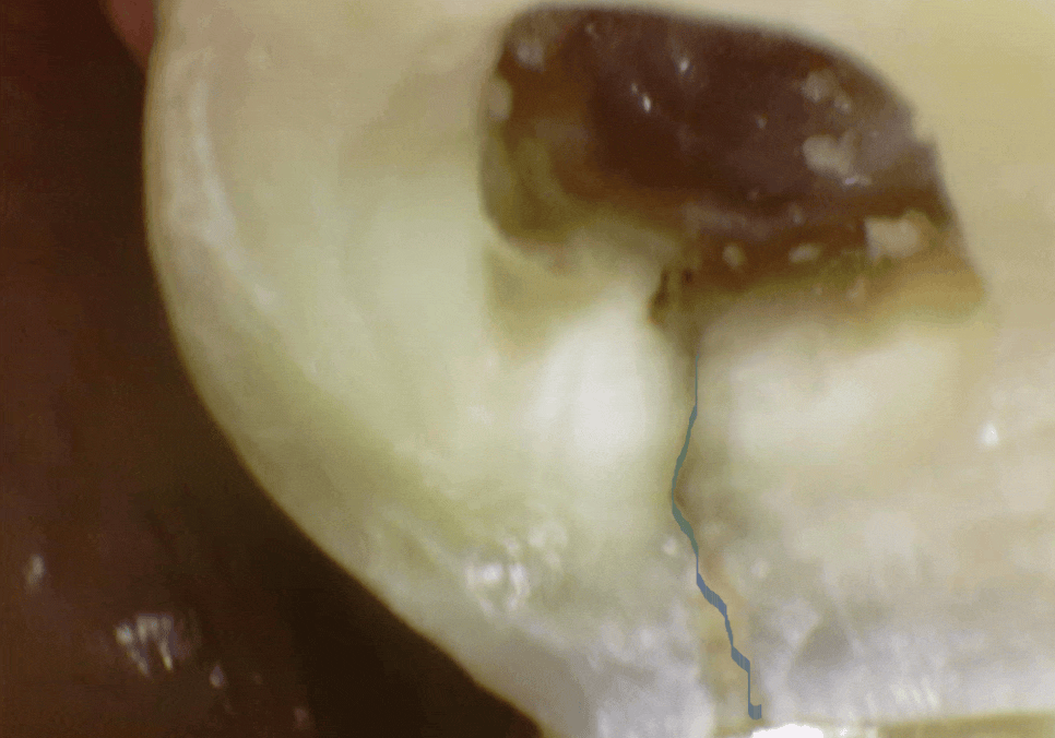 시큰거리는 통증, 시린 이 치약으로 해결 안 된다고요? 관련 이미지 8