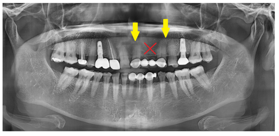 길동 치과 임플란트 수술 대안은 없을까요???? 관련 이미지 2