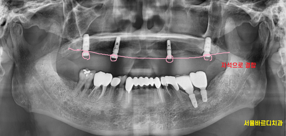 고덕역 치과 전체 치아 상실 시 자석 틀니 오버덴쳐가 해답이 될 수 있습니다. 관련 이미지 6