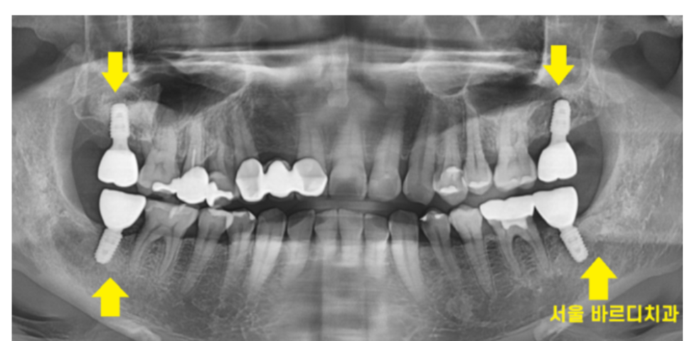 맨 끝 어금니 임플란트 먼저 무너지는 이유가 있습니다. 관련 이미지 5