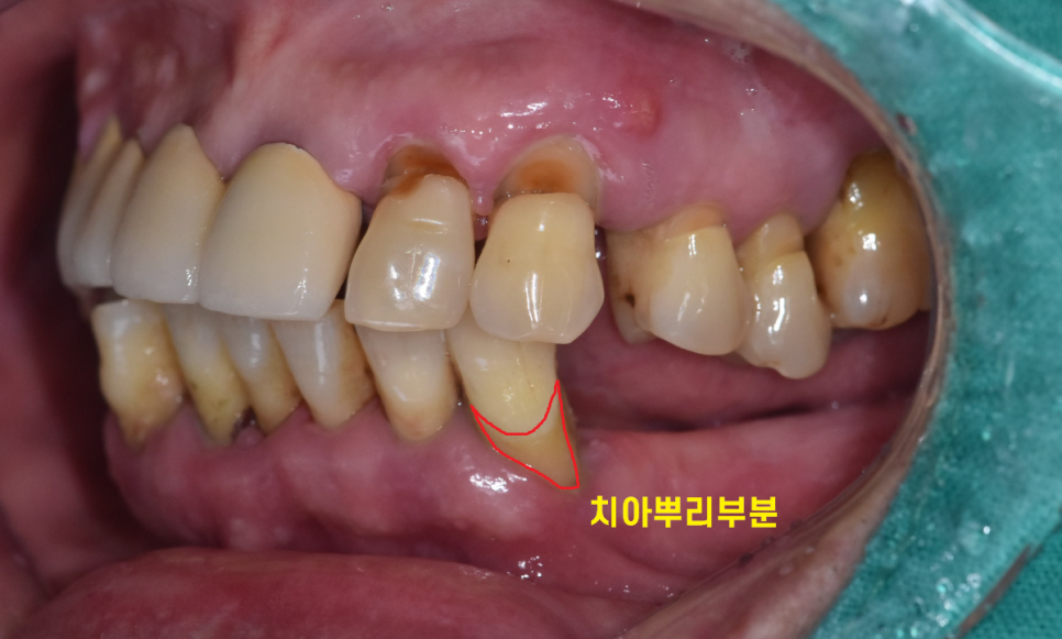 고덕 치과 잇몸 무너짐 천천히 진행되어서 더 무섭다. 관련 이미지 6