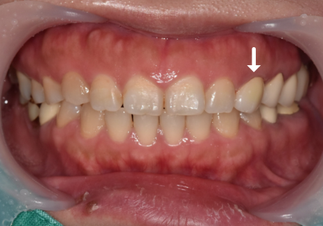 앞니가 검게 변색된 이유, 신경치료 후 꼭 크라운으로 씌워야 하는 걸까요? 관련 이미지 10