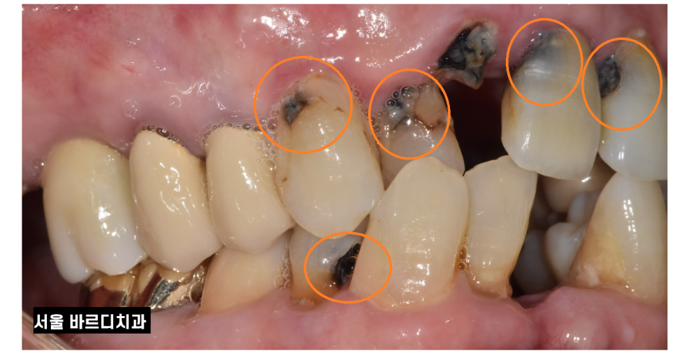 입 마름 치근 우식증이 쉽게 생길 수 있습니다!! 관련 이미지 2