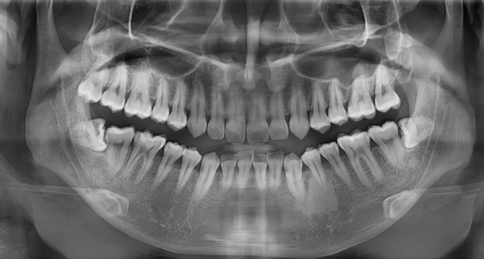 매복 사랑니 발치 후 냄새 드라이소켓 증상일 수 있습니다 . 관련 이미지 3