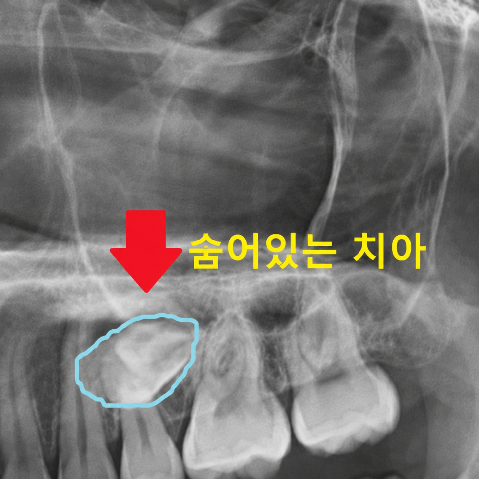 Is a University Hospital the Answer for Extracting a Completely Impacted Tooth? image 1