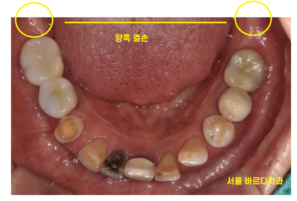 암사동 치과 골다공증 치료 중 임플란트 가능한가요?? 관련 이미지 6