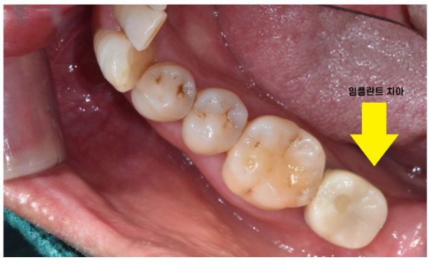 하남시청치과 내비게이션 임플란트 왜 좋다는거죠? 관련 이미지 10