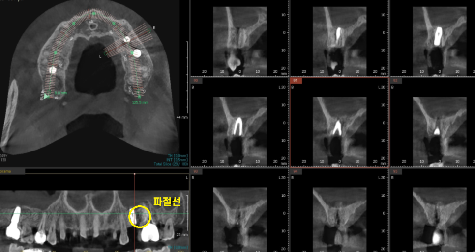 길동 치과 임플란트 보철 흔들림 교체 해야할 경우 관련 이미지 5