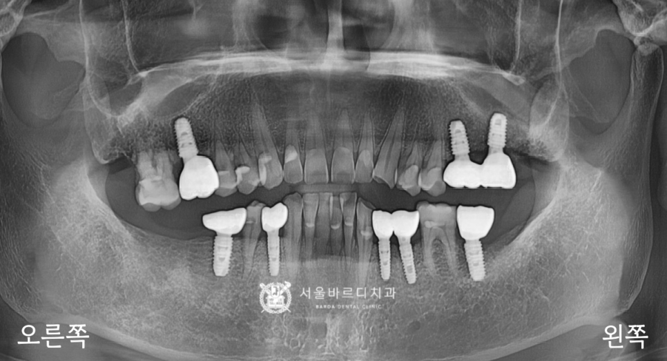 고덕동치과 서울바르디치과 무절개 네비게이션 임플란트 치료증례 #1 관련 이미지 18