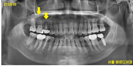고덕동 치과 잇몸 주저앉음 느낌이 들었다면 늦었을 수도 있습니다. 관련 이미지 2
