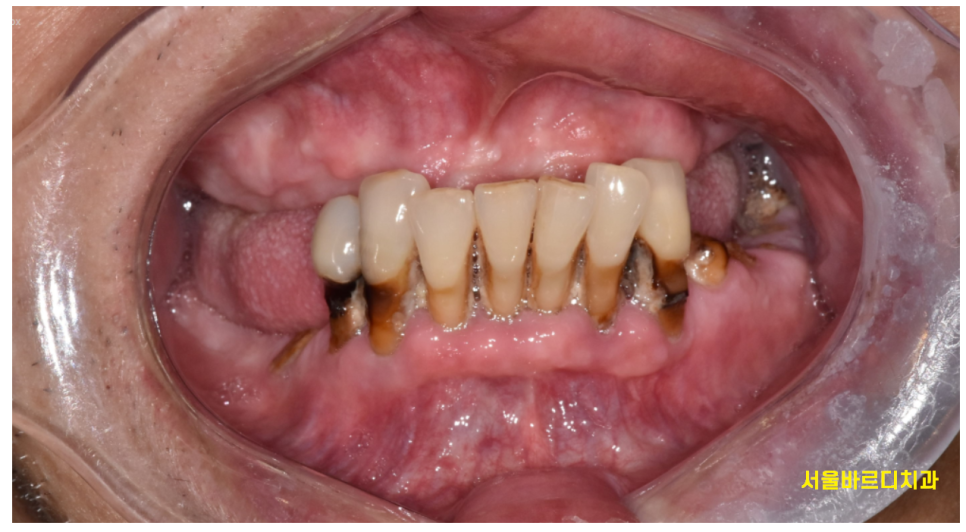 고덕역  치과 틀니쓰다 위아래 전악 임플란트 재건했습니다. 관련 이미지 2