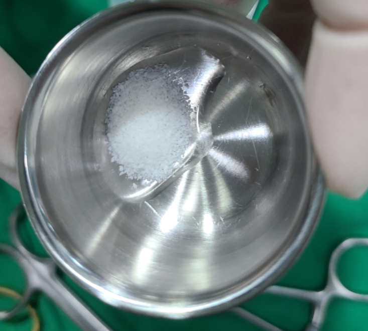 고덕동 임플란트 골이식 필수일까? 궁금증 여기 모두 있어요 관련 이미지 8