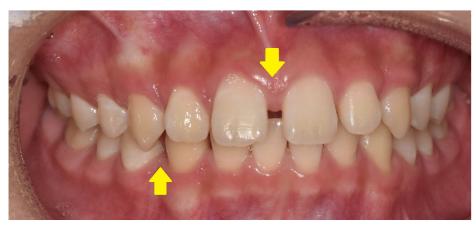 벌어진 앞니 치아 교정 통해 공간 닫기 장점이 많습니다. 관련 이미지 2