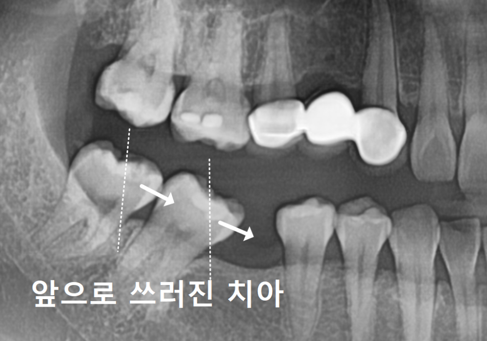 No space for an implant because a tooth has fallen over or a molar has tilted? Read this first. image 6